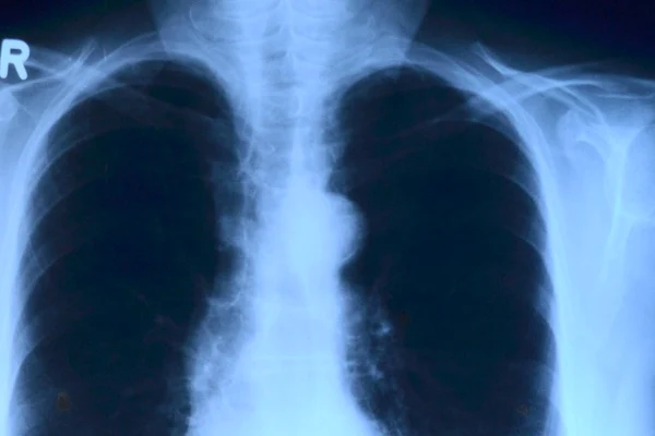 Startup-ul XVision a lansat prima aplicație din România pentru radiografii pulmonare