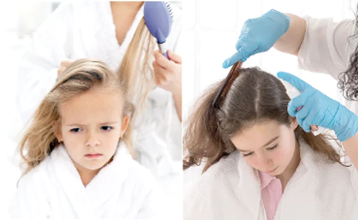 Păduchii trăiesc pe scalp şi depun ouăle la rădăcina firului de păr