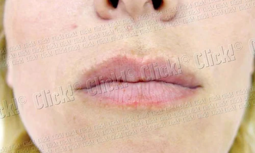Şi a mărit buzele  cu injecţii jpeg