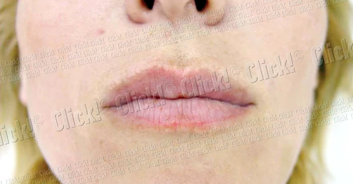 Şi-a mărit buzele  cu injecţii