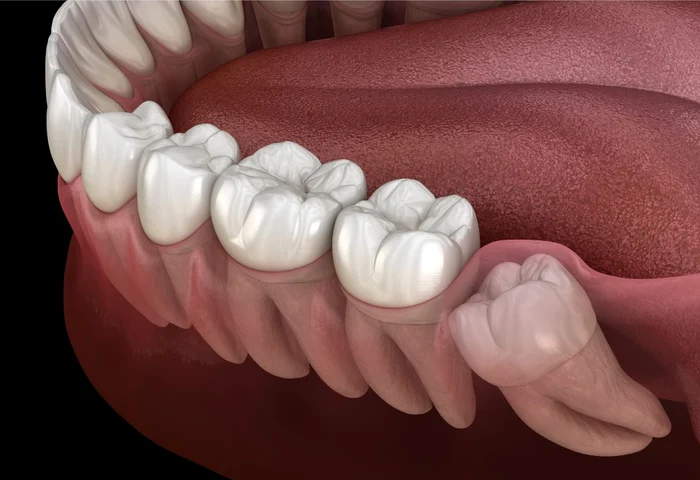 Extracția și tratamentul molarului de minte. FOTO: Atria Dental