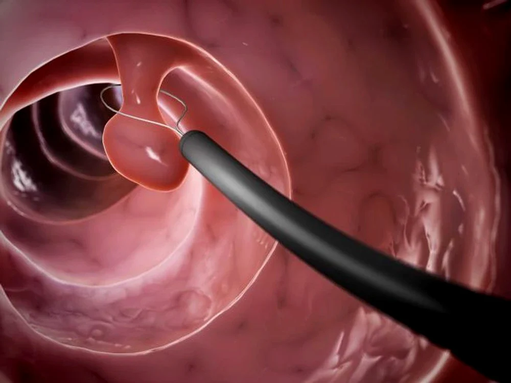 polip colon jpg