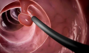 polip colon jpg