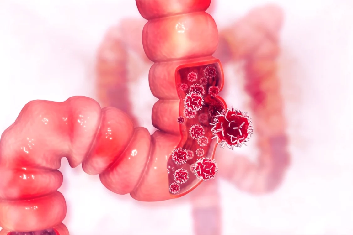 Cancer colorectal Foto:Shutterstock