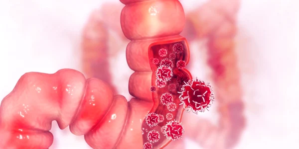 cancer Colorectal 