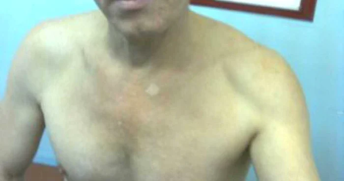 Bărbatul a dormit liniștit 12 ore cu un cuțit înfipt în piept