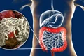 paraziti intestinali jpg