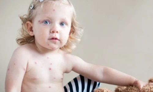 Cât de importantă este dieta sănătoasă când copilul are varicelă jpeg