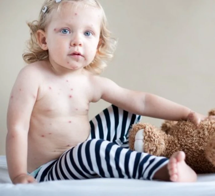 Cât de importantă este dieta sănătoasă când copilul are varicelă jpeg