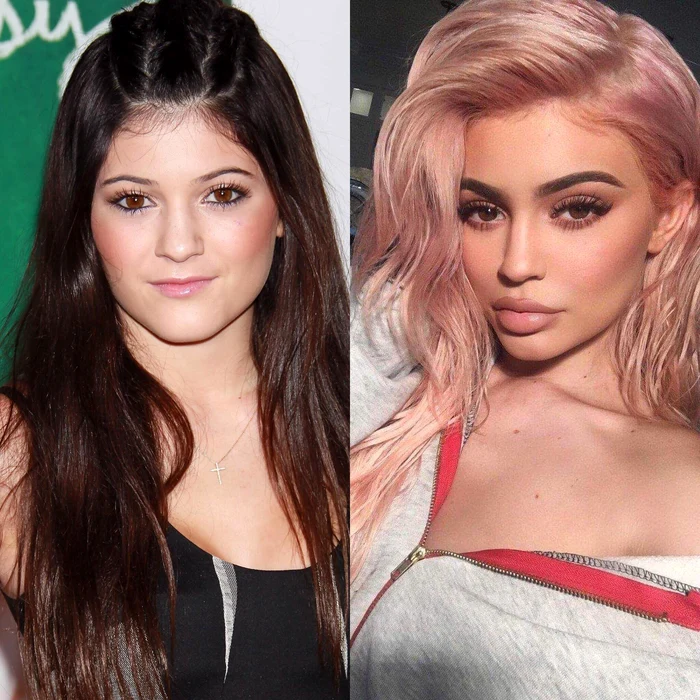 Kylie Jenner a fost adesea acuzată de către fani că a exagerat cu operațiile ei estetice