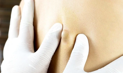 1 simptomele furuncului de la ce apare si cum il tratam jpg jpeg