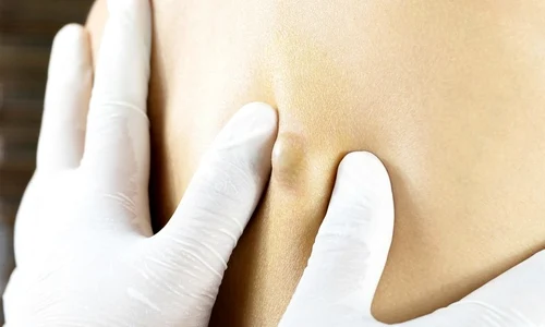 1 simptomele furuncului de la ce apare si cum il tratam jpg jpeg