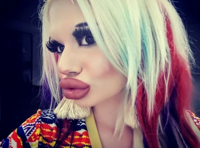 Tânăra și-a făcut 15 intervenții la buze
