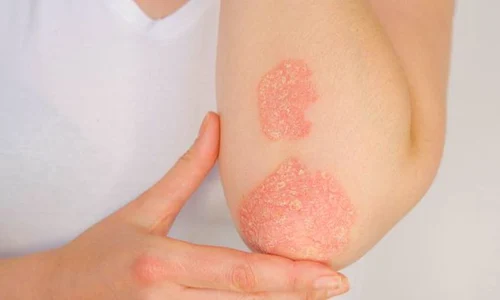 1 psoriazis jpg jpeg