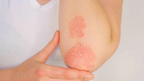 1 psoriazis jpg jpeg