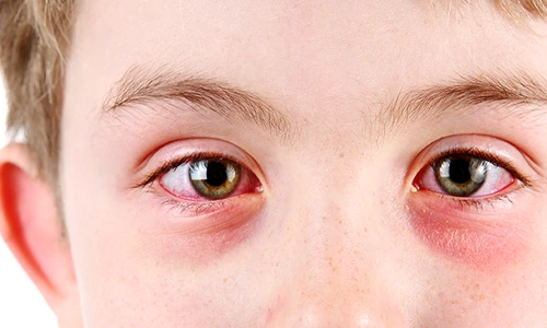 1 conjunctivita la copii png png