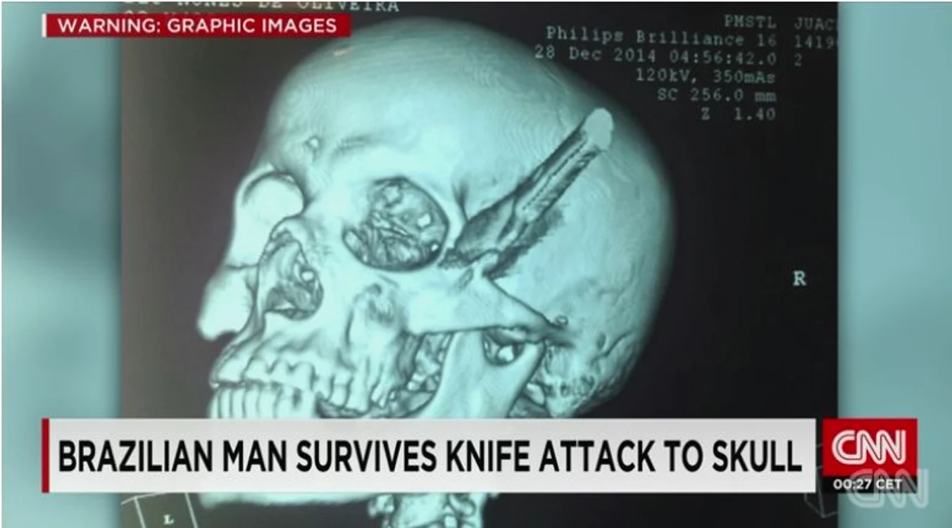 CNN a relatat cazul bărbatului brazilian