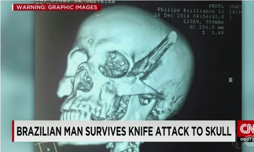 CNN a relatat cazul bărbatului brazilian jpeg