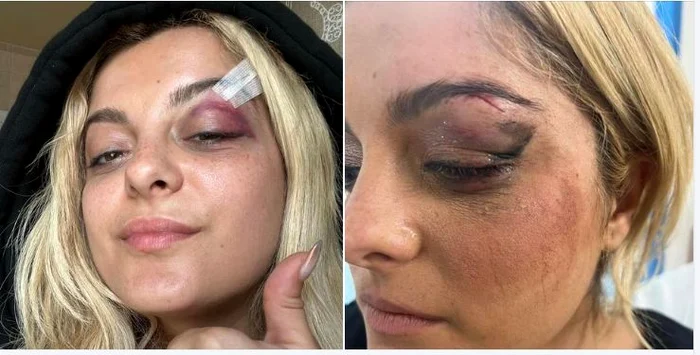 Bebe Rexha, lovită de un telefon în plină figură Sursa: Instagram