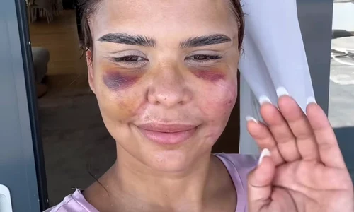 "Încă foarte umflată și cu vânătăi, dar abia aștept rezultatul final", spune Andreea Popescu