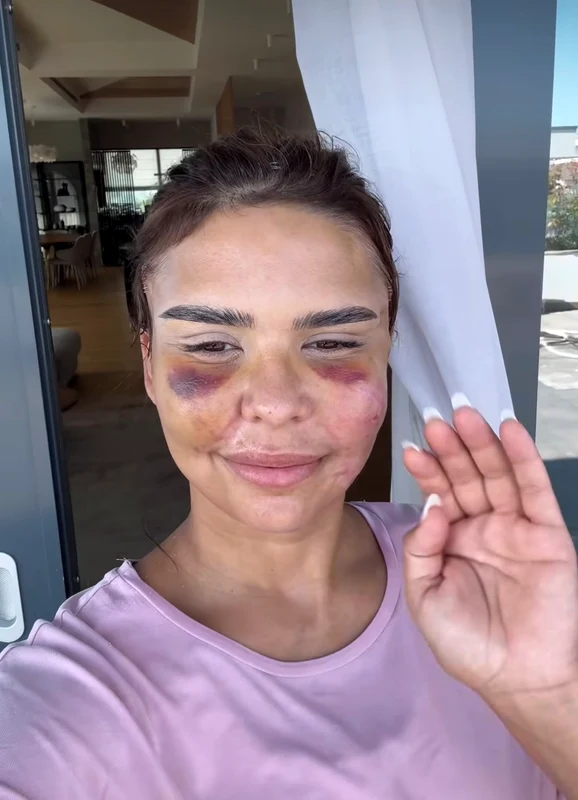 "Încă foarte umflată și cu vânătăi, dar abia aștept rezultatul final", spune Andreea Popescu