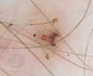 pubic louse 1 WatermarkedWyJXYXRlcm1hcmtlZCJd jpg