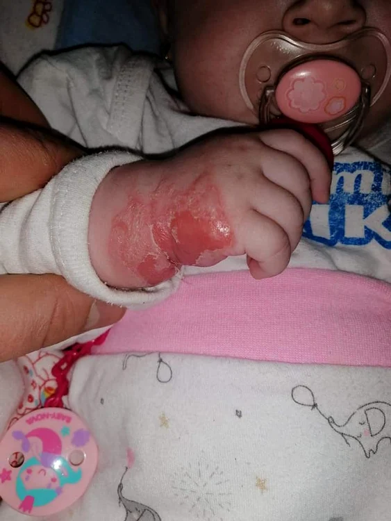 
    Medicii susțin că este doar o alergie la leucoplastFoto: Facebook  