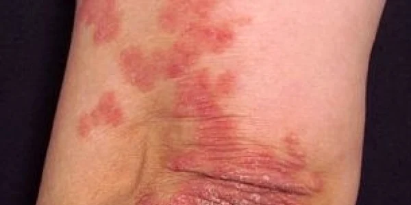 psoriazis