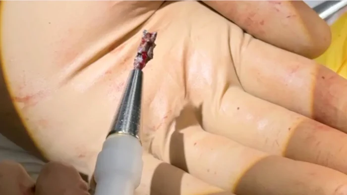 Instrumentul cu magnet cu ajutorul căruia se extrag schijele din corp. Foto: Dnipro Cardiac Center