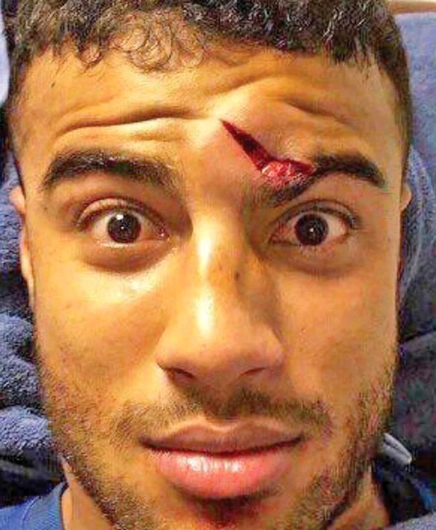 
    Rafinha a rămas  cu o urmă urâtă  pe frunte   