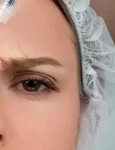 cover Riduri fine sau profunde Află cum Toxina Botulinică poate face minuni jpg