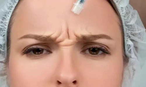 cover Riduri fine sau profunde Află cum Toxina Botulinică poate face minuni jpg