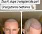 Sorin Brotnei a făcut cel de-al doilea transplant de păr foto: Instagram