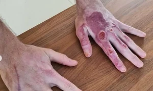 Așa arată mâinile lui Romain Grosjean la 50 de zile după accidentul din Bahrain jpeg