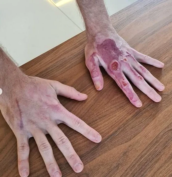 Așa arată mâinile lui Romain Grosjean la 50 de zile după accidentul din Bahrain