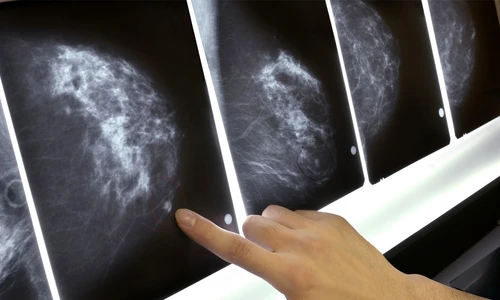 1 nodulii mamari jpg jpeg