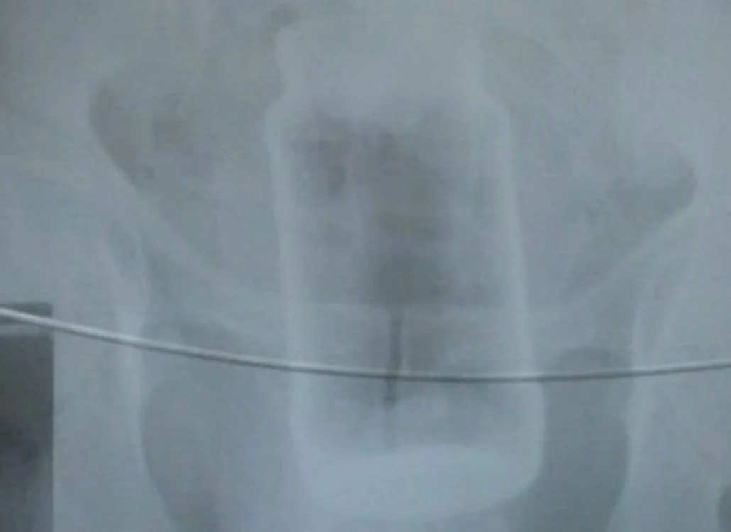 Borcanul - "corp străin", vizibil pe radiografie.
