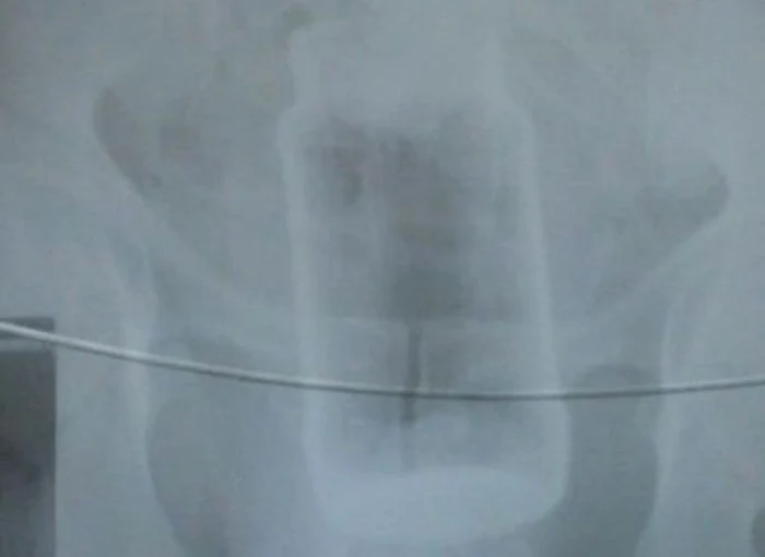 Borcanul - "corp străin", vizibil pe radiografie.