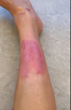 Kim Kardashian, psoriazis jpg