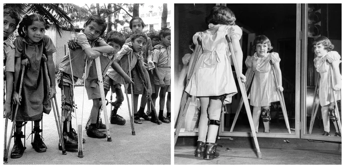Poliomielita, boala copilăriei în anii ’50 / FOTO: Colaj arhivă