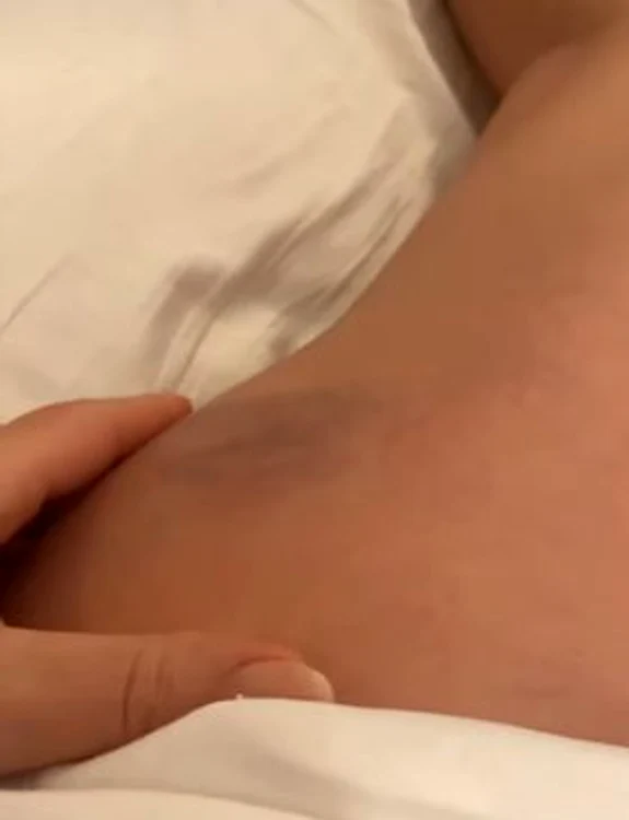 Gina Pistol s-a ales cu o vânătaie în urma căzăturii