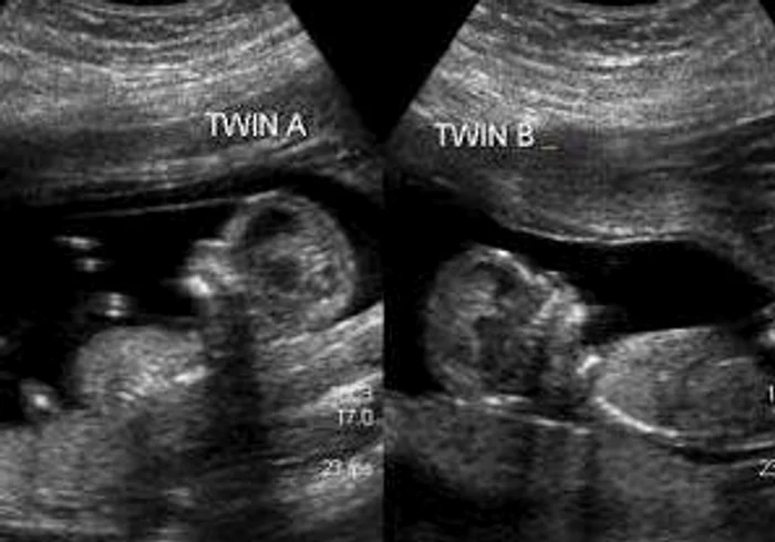 Adriana Iovi Stere le-a arătat prietenilor de pe Facebook ecografia în care se pot vedea băieţeii ei