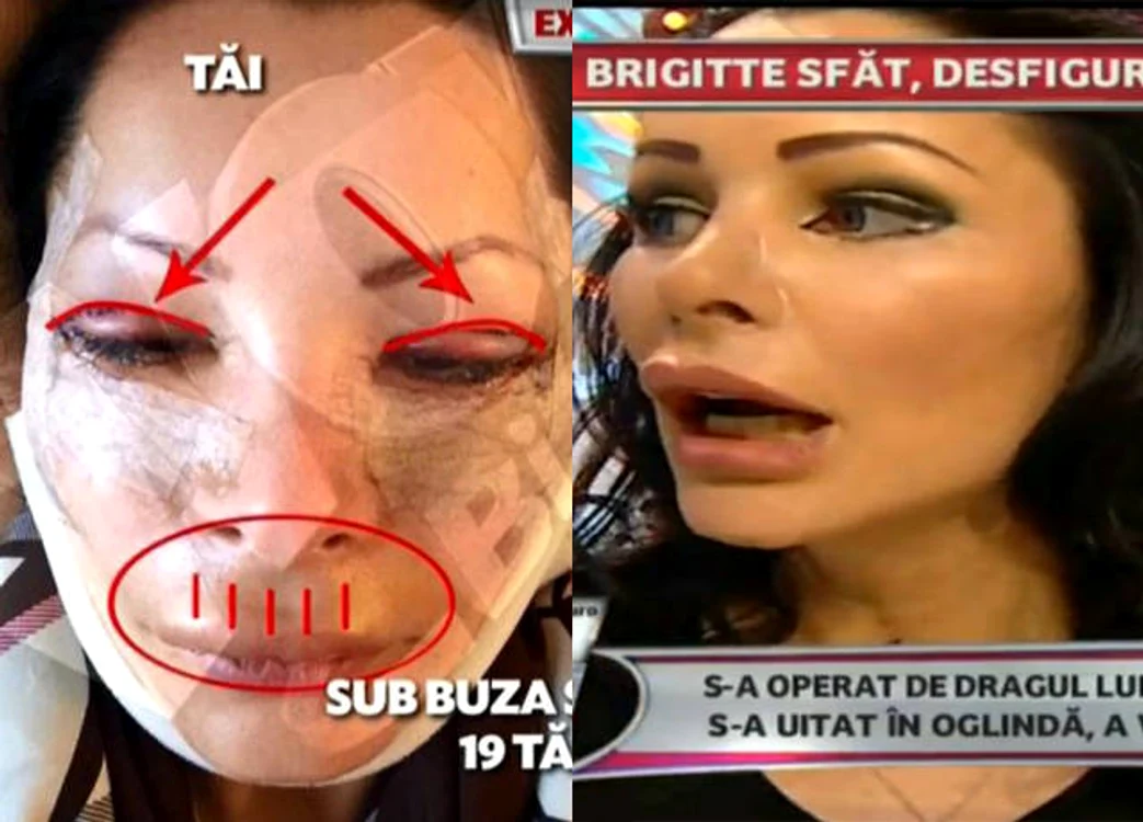 Aşa arăta bruneta, imediat după operaţie