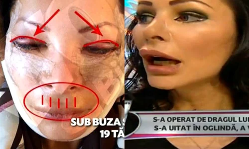 Aşa arăta bruneta, imediat după operaţie jpeg