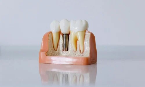 Implanturi dentare o reînnoire a zâmbetului (2)(1) jpg