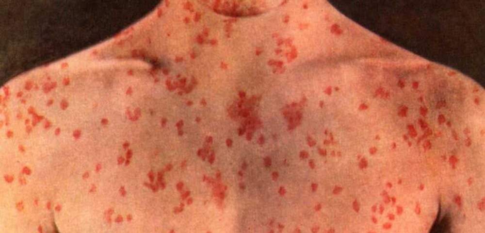 O femeie de 24 de ani, nevaccinată, a murit din cauza rujeolei. Este al șaselea deces în ultima perioadă