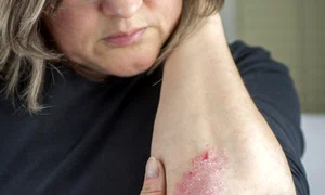1 psoriazis 28821749 xl jpg jpeg