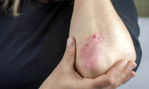 1 psoriazis 28821749 xl jpg jpeg