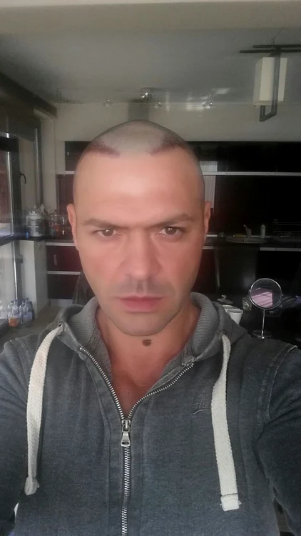 Cornel Păsat, imediat după intervenţia chirurgicală