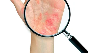 12 1 sante 2  1col psoriazis vulgar jpeg